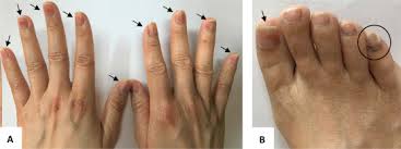 paaxel nail toxicity