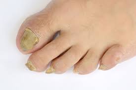 fungal nail treatment options in