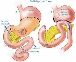 post gastrectomy t