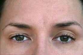 what causes droopy eyelids the truth