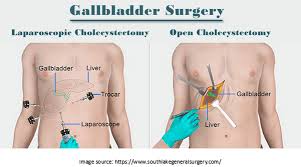 chest pain after gallbladder surgery