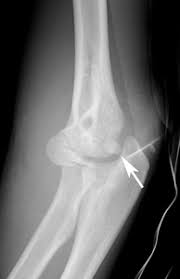 Related online courses on physioplus. Clinical Practice Guidelines Medial Epicondyle Fracture Of The Humerus Emergency Department