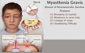 Prevalence = 14.2 cases per 100,000. Breaking Covid 19 News Italian Researchers Report That Sars Cov 2 Can Trigger Myasthenia Gravis A Neuromuscular Disease Thailand Medical News