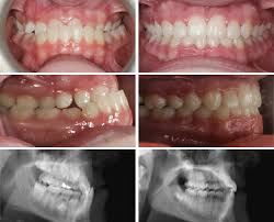 How can you fix an overbite without surgery? Before And After Darmitzel Orthodontics Santa Fe Nm