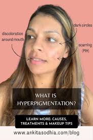 hyperpigmentation everything you need