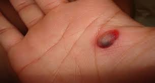 blood blisters