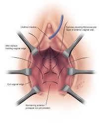 pelvic organ prolapse