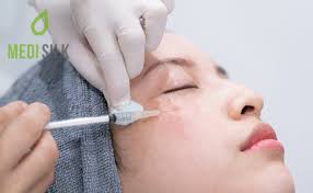 dermal fillers for acne scars the
