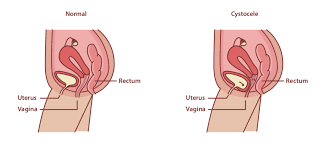pelvic organ prolapse causes symptoms