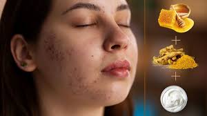 turmeric face pack for pimple marks