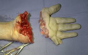 Image result for HAND TENDON SURGERY