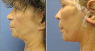 facelift surgery before and after