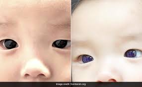 baby s dark brown eyes turn blue after