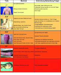Wound dressings, cleansing and additional treatment methods including grafting are health care professionals encounter burns in their patient populations frequently, and must be able to differentiate between types of burns, as well. Recommendations For The Treatment Of Severe Burn Injuries In The Field Military Medicine Worldwide