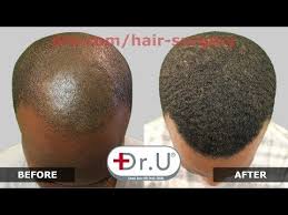 With surgical** hair restoration, your natural hair will grow and restore your hairline and thinning areas of your scalp, permanently. Best Hair Transplant In Los Angeles La Dr Ugraft Bht Fue Hair Restoration Surgeon Dr U Hair Clinic Youtube Help Hair Loss Fue Hair Transplant Hair Surgery