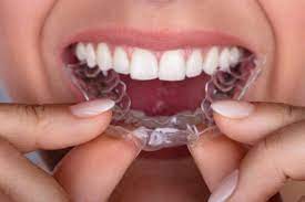 Although not as tight as they. How Long Do I Have To Wear A Retainer After I Have Braces
