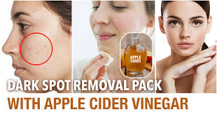 apple cider vinegar to get rid of acne