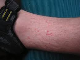treating flea bite rash effectively