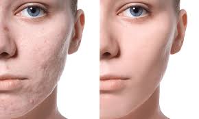 laser acne scar removal does it work