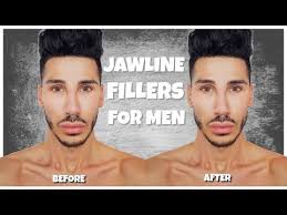 Our doctors are experts in this dermal filler procedure. Jawline Filler For Men Flawless Cosmetic Youtube