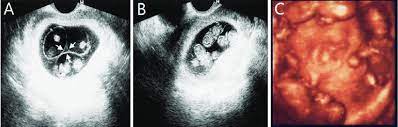 At 5 weeks pregnant, your baby is about the size of a pop rocks crystal. A Transvaginal Ultrasound Performed At 8 5 Weeks Gestation Reveals Download Scientific Diagram