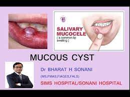 mucous cyst in lip information in
