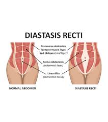 Diastasis recti happens when the midline of the abdominals starts to stretch, causing a separation where your abdominal muscles should meet. Diastasis Recti Causes Of Ab Seperation During And After Pregnancy