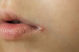 angular cheilitis is not a cold sore on