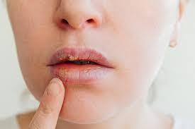 lips what is cold sores herpes