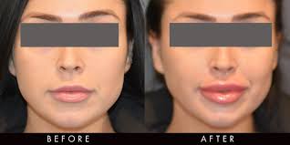 Common areas to inject fillers are in the face, neck, and hands, resulting in a fuller, smoother and more youthful appearance. Before After Dermal Fillers Vamp Clinic Newcastle