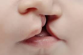 about cleft lip and palate
