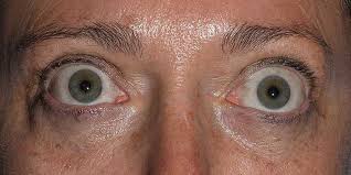 what is graves eye disease obn