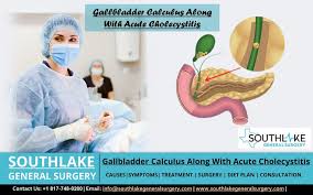 gallbladder calculus plus acute