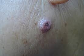 like squamous cell carcinoma