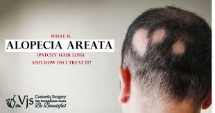 alopecia areata patchy hair loss