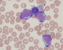 Acute Megakaryoblastic Leukemia Eclinpath