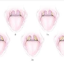Standardized Tonsillar Hypertrophy Grading Scale 0