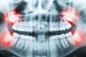 types of wisdom teeth removal south