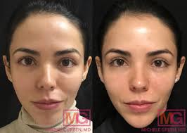 juvederm under eyes nyc injectable