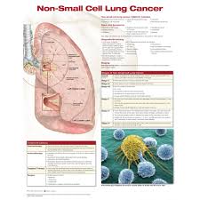 Non Small Cell Lung Cancer Chart Poster Laminated