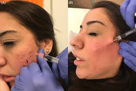 atrophic acne scars