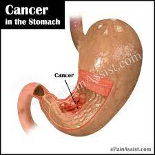 Smoking tobacco may increase the risk of cancer developing in the part of the stomach near the esophagus. Cancer In The Stomach Causes Symptoms Stages Treatment Survival Rate