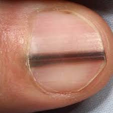 what do nail problems mean for your health