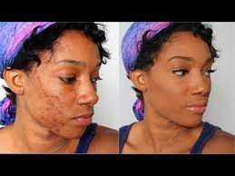 how to fully cover acne spots and scars