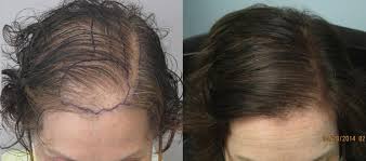 Hair transplant & restoration in los angeles. Women S Hair Transplant Los Angeles Female Hair Restoration Dr Sean
