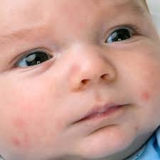 Learn out about causes in children and adults, seven different. Baby Acne And Other Newborn Face Rashes Babycenter