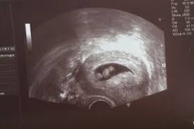 Ich bin in der 7 ssw , 6+1 und man hat leider nur eine fruchthöhle und einen dottersack. Ultraschallbilder In Der 7 Ssw Forum Schwangerschaft Urbia De