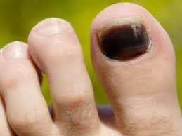 If you are diagnosed with melanoma, your doctor will go over the next potential treatment options for. Black Toenail 6 Potential Causes