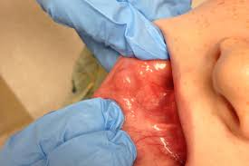 derm dx lump on the inner surface of