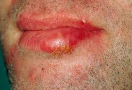cold sore herpes simplex lesion on